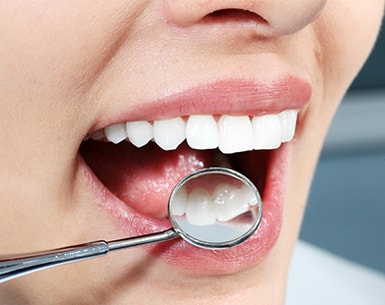 Woman with white teeth getting a dental examination with a mirror