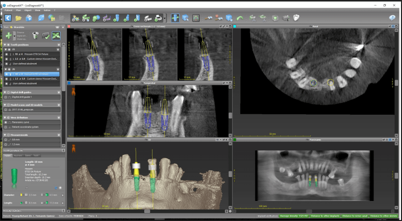 Implant Bridge
